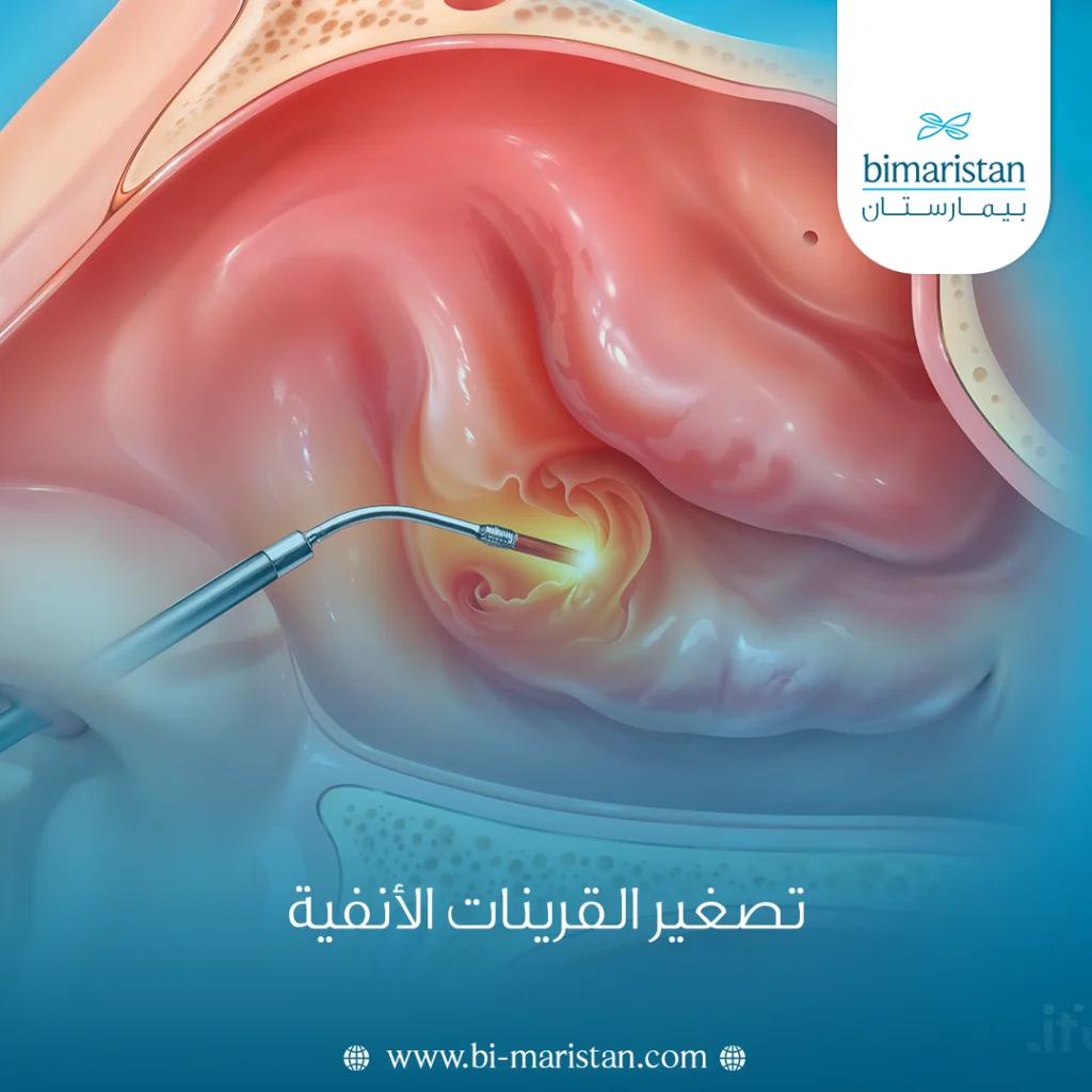 تصغير القرينات الأنفية