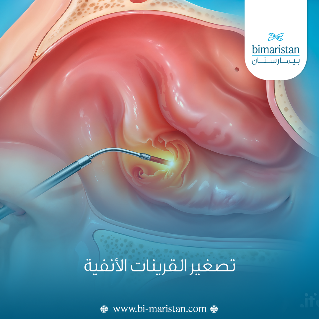 تصغير القرينات الأنفية