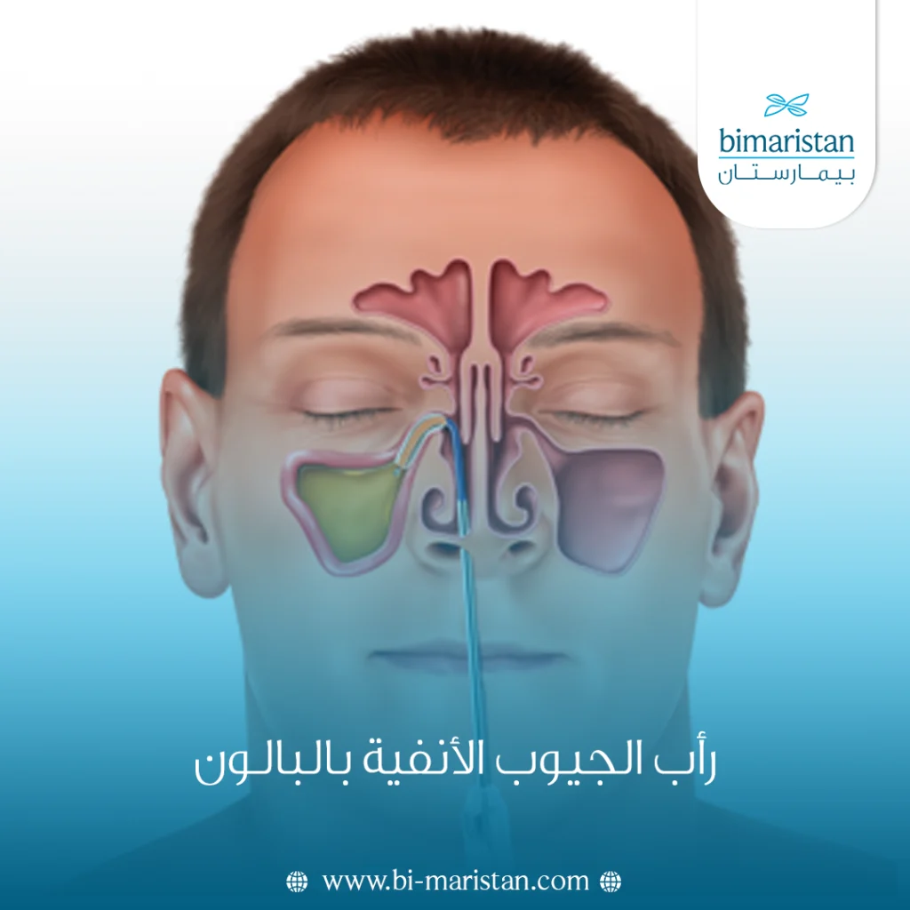 رأب الجيوب الأنفية بالبالون