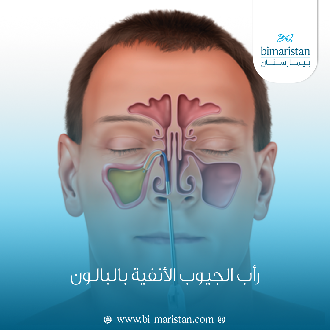 رأب الجيوب الأنفية بالبالون