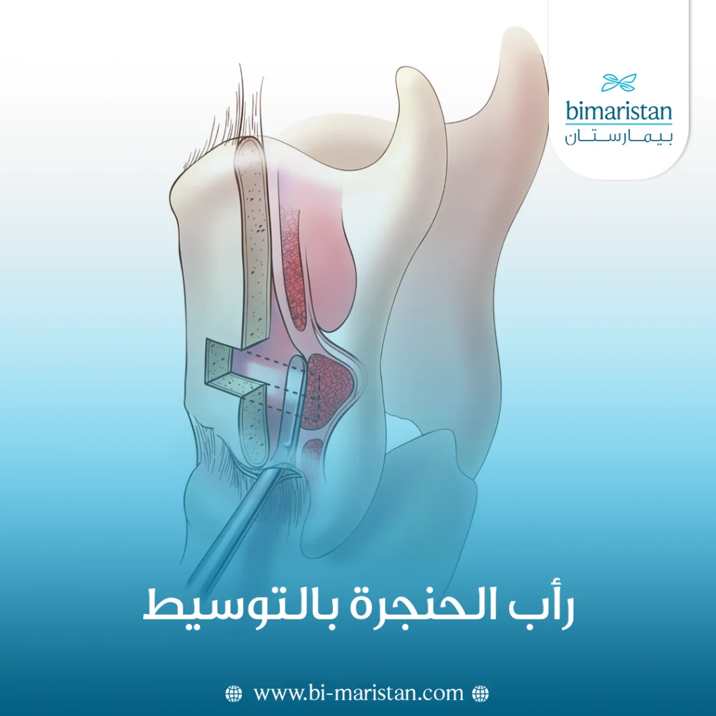 رأب الحنجرة بالتوسيط